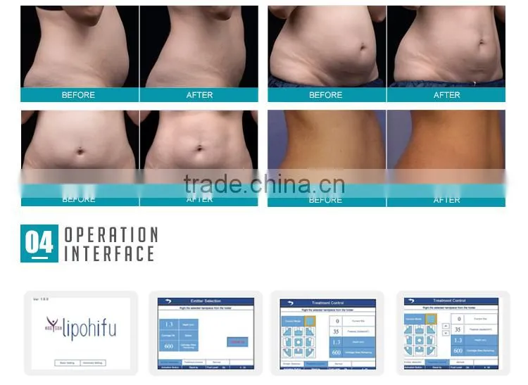 liposonix machine