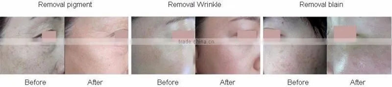 2016 New& hot Rf Laser Fractional Co2 Laser For Scar Removal Etc