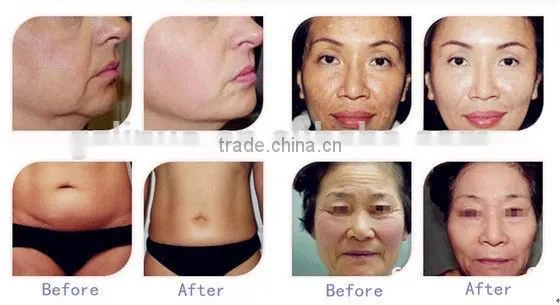 China top ten selling products soft fractional rf my orders with alibaba