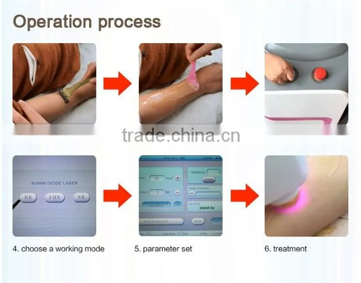 High Power 808nm diode laser permanent hair removal machine