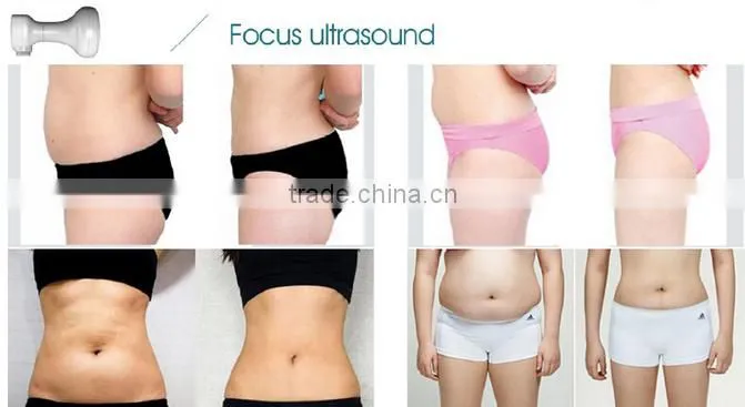 high intensity focused ultrasound HIFU for body slimming machines hifu system / portable hifu machine / ultra age hifu ultraform