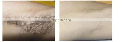 2012professional laser hair tattoo removal machine P003