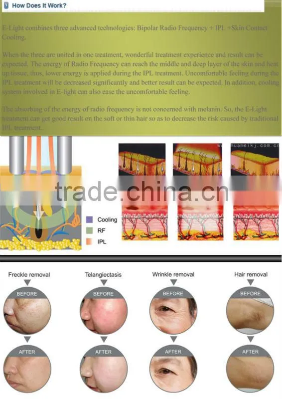 powerful ipl hair removal machine (TGA approval ) with trolley