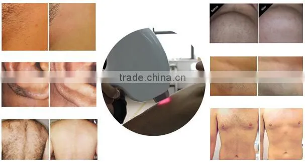 2015 latest innovative epila 808nm diode laser hair removal machine low price