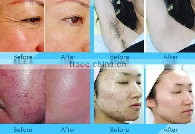 vertical shr Elight hair removal