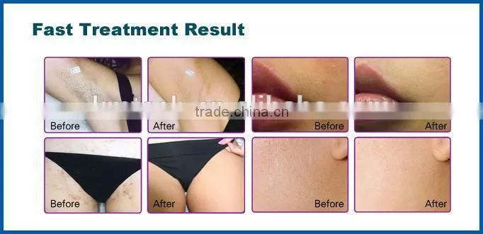 2016 factory discount laser hair removal machine price/808nm diode laser machine