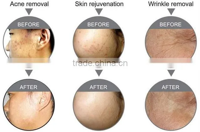2011 Photon dynamical nurse therapy-PDT/LED Skin Care and skin rejuvenation with seven LED gene biology light
