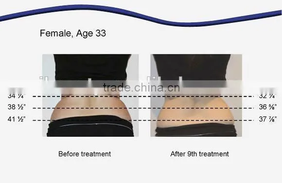 Fat Cavitation Device For Home/Weight Loss Machine