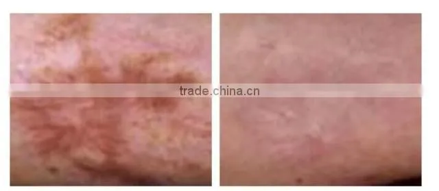 facial skin lifting and tightening fractional co2 laser/vaginal tightening co2 laser machine