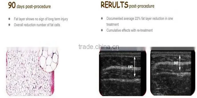 New design in 2016 fast slimming equipment cryolipolysis machine lose weight from china