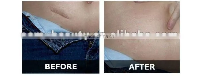 Dermaroller 540 needles injectable collagen photon microneedle therapy L001