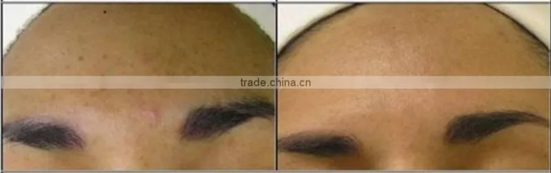 factory newest skin care device for spa salon equipment with OEM