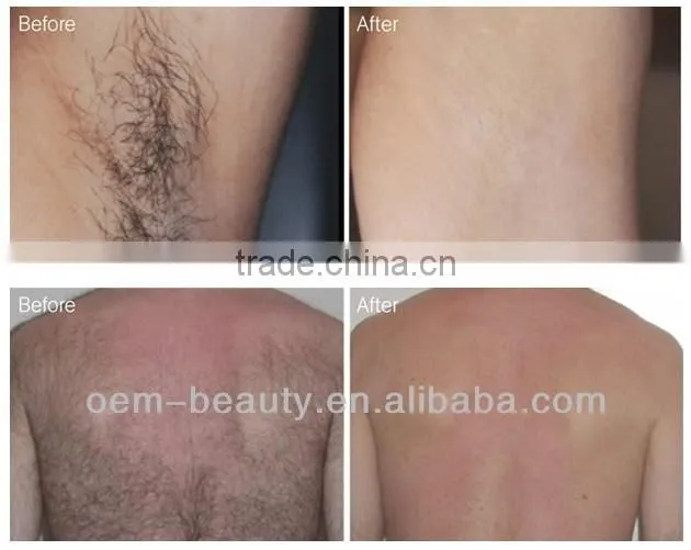 Home nd yag hair removal 1064 laser depilation onychomycosis device
