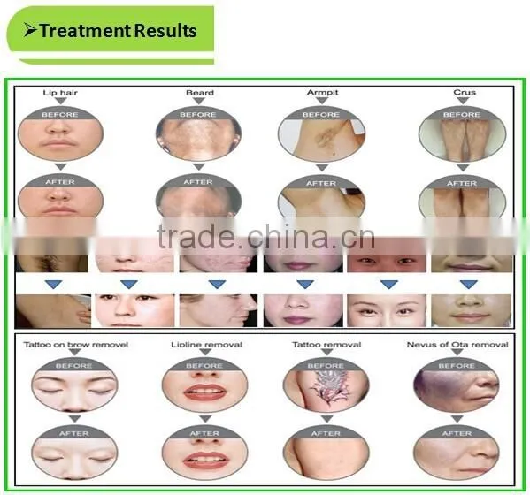 Super combination of SHR fast hair rermoval, laser tattoo removal, IPL home use hair removal machine
