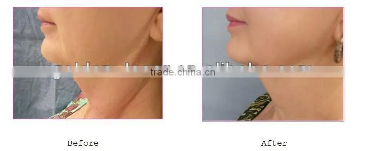 2014 New Style Face and neck tightening and firming Viora Reaction Machine