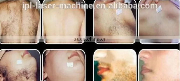 Best IPL Skin Rejuvenation/Anti Ageing ipl laser machine