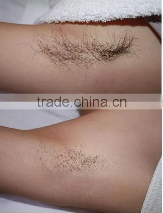 810 DIODE LASER HAIR REMOVAL