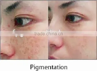 Ipl elight laser 5 in 1 hair removal beauty equipment