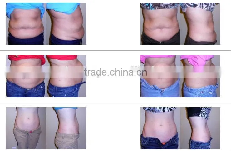 Alibaba China Suppier radio frequency?device photon light therapy machine cavitation slimming machine,New face NV-i3