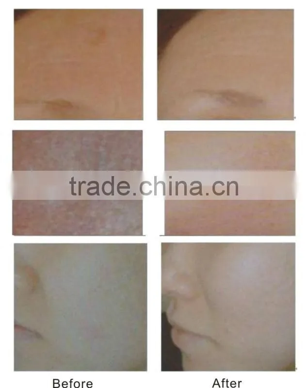 Medica Skin fractionated co2 laser resurfacing