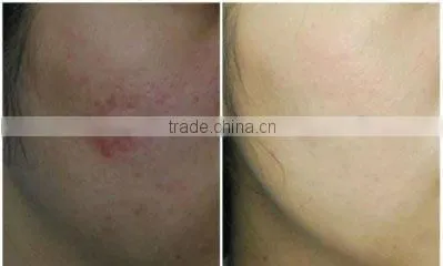 wholesale microneedle 540 derma roller