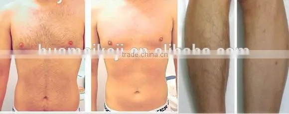 diode laser smooth hair removal machine