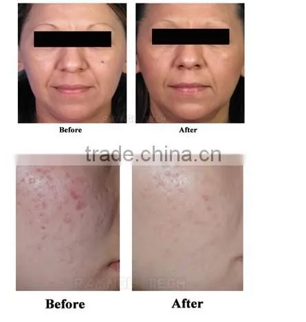 EO Q switch ND: YAG LASER1