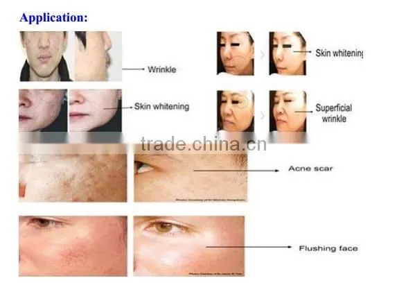 2016 PINXEL-2 Microneedle RF and Fractional RF beauty Machine/ monopolar rf face ce/ radio frequency facial treatment