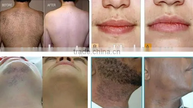 Best popular technology 808nm diode laser for hair loss
