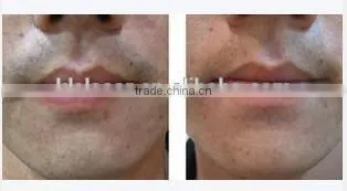 Wanted Distributor permanent hair removal for men machine home use