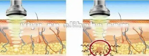 VY-M2A Home use ultrasonic vacuum cavitation machines for body slimming