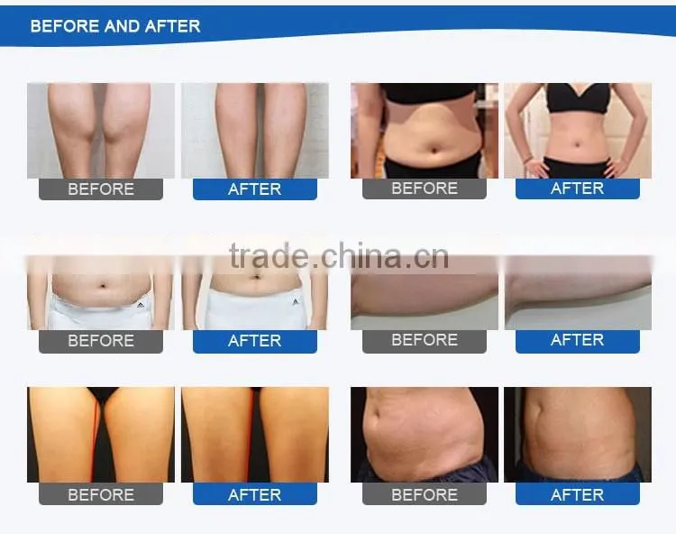 2017 Hottest wholesale cryo + cavitation + RF technologies vertical cooltech fat freezing machine