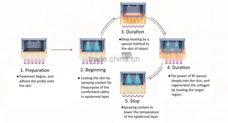 New Face NV- V500 2017 China supplier radio frequency neck lift rf equipment for skin tightening