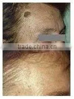 Portable Mobile Spa Equipment 1064nm Laser Hair Removal Machine -P003