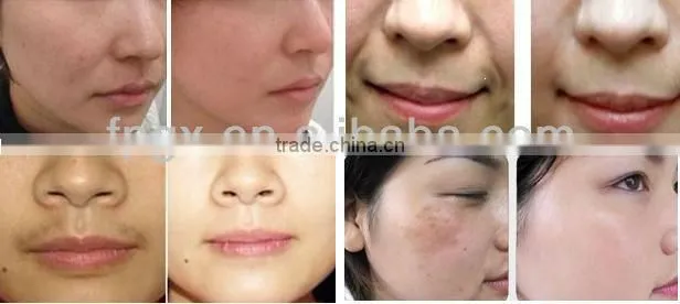 Hair Removal & Wrinkle Removal Beauty Equipment of E-light IPL RF