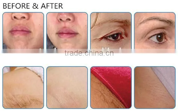 RF Medical Device For Wrinkle Removal Face Lifting Face Shaping Skin Penetration Depth 1.5mm / 2.5mm / 4.0mm