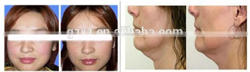 CE approved non surgical face lift machine / fractional rf microneedle / best rf skin tightening face lifting machine