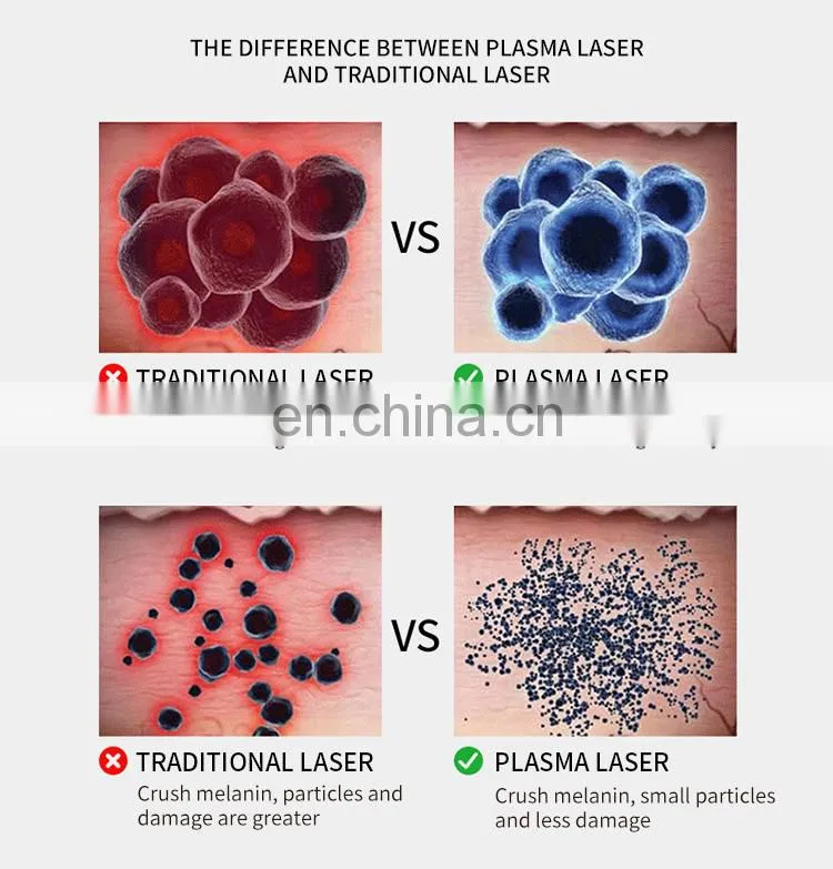 2 in 1 Ozone Plasma Pen Spot Removal Anti-Acne Beauty Instrument Scar Wrinkle Removal Face Lift Anti-aging Laser Beauty Machine