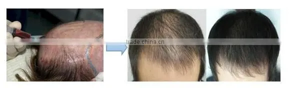 Patent PRP tube in China