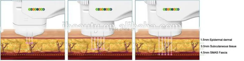 2015 professional portable HIFU High Intensity Focused Ultrasound HIFU with 3 tips for wrinkle removal