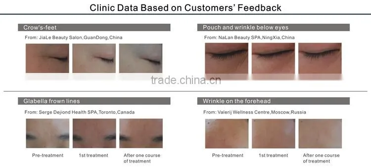 Amb-Master Race best selling skin rejuvenation equipment(CE,ISO13485)