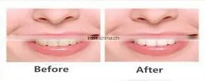 Dental Teeth Whitening Strips in teeth whitening