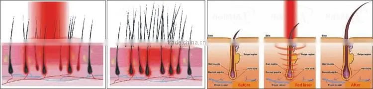 2013 hot! wholesale suslaser hair loss treatment machine BL005 CE/ISO suslaser hair loss treatment machine