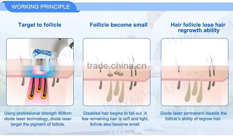 2016 painless wax hair removal ! 808nm diode laser hair removal machine for salon use