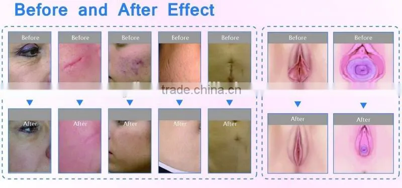 CO2 medical Laser equipment CO2 fractional laser resurfacing system