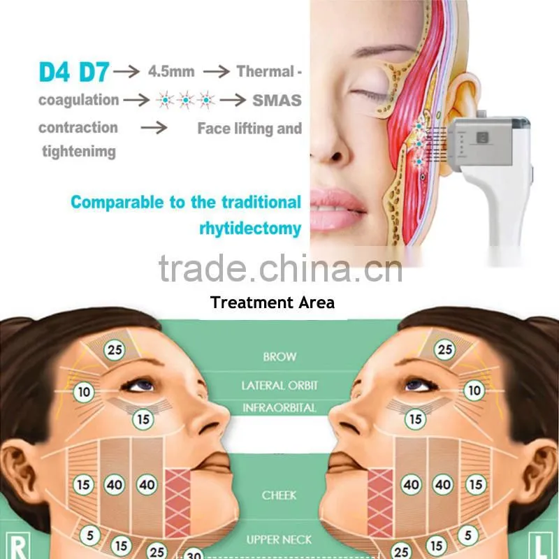 No recovery ultrasound hifu SMAS hifu face lift for salon beauty