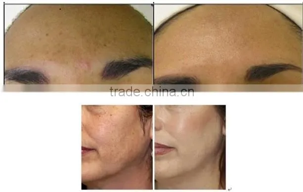 Professional portable salon equipment diamond microdermabrasion jet oxygen spray diamond peeling facial rejuvenation machine