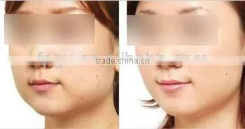 Manufacture Supplied Portable Hair Removal IPL Machine