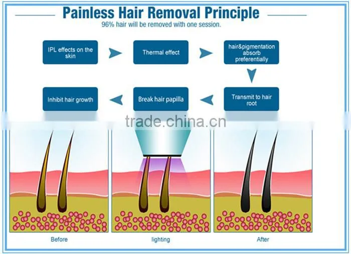 latest technology diode laser hair removal machine
