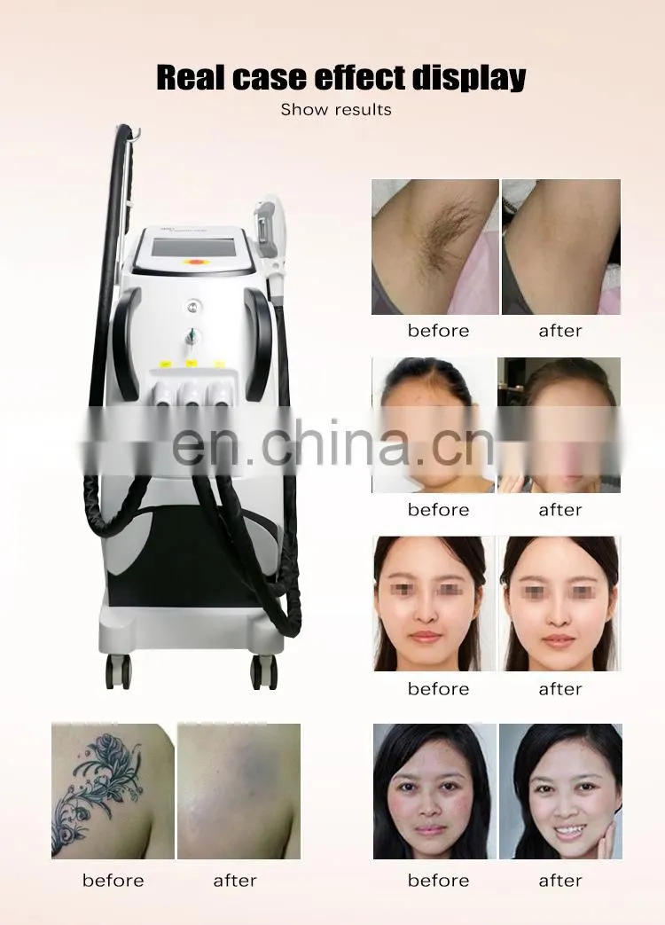 High quality hair removal beauty machine e-light ipl rf q-switched nd yag laser 3 handle